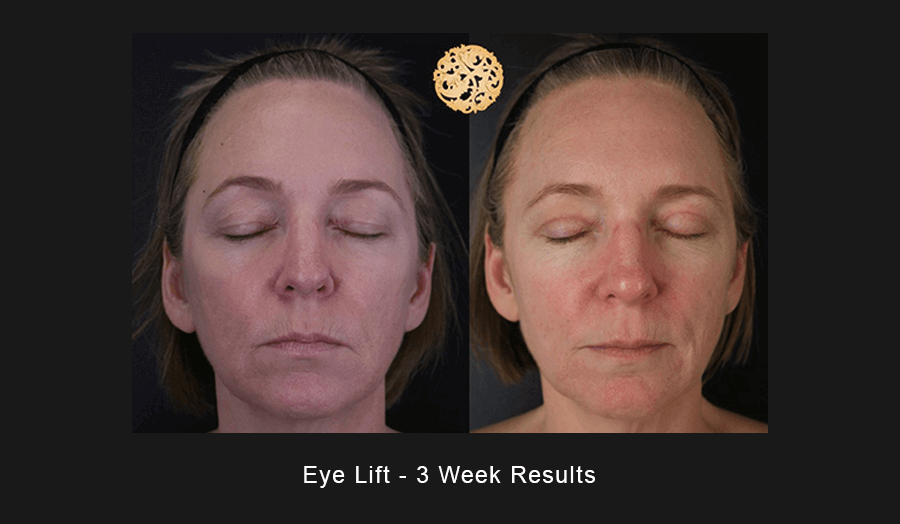 Blepharoplasty Before & After