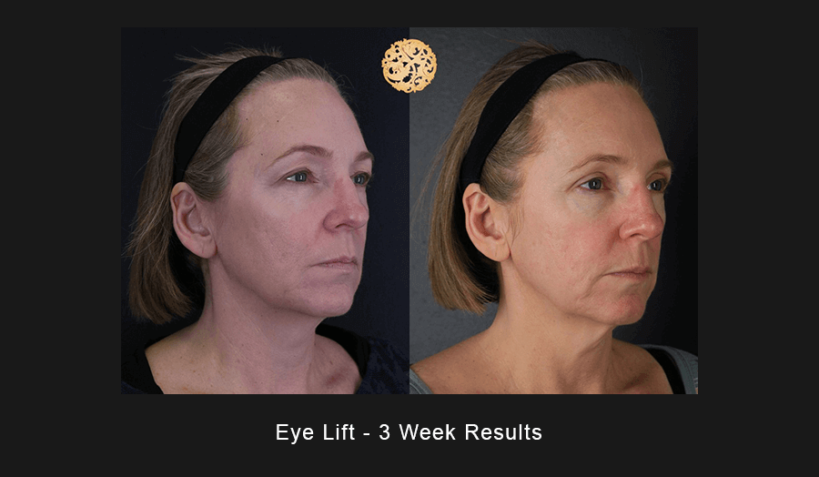 Blepharoplasty Before & After