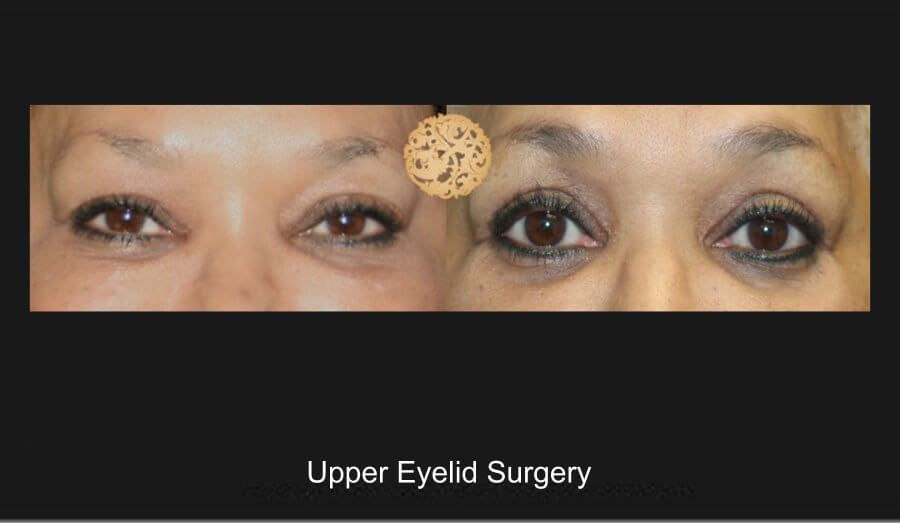 Blepharoplasty Before & After