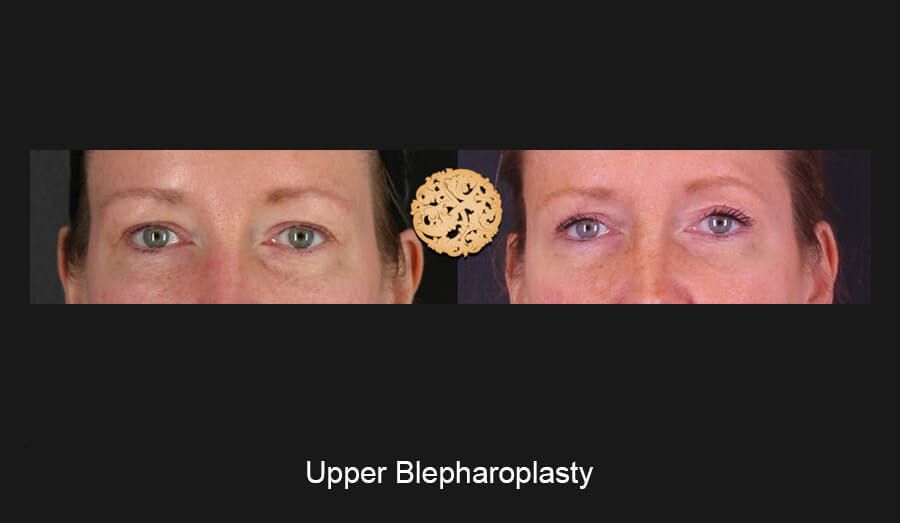 Blepharoplasty Before & After