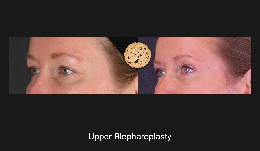 Blepharoplasty Before & After