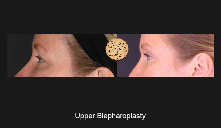 Blepharoplasty Before & After
