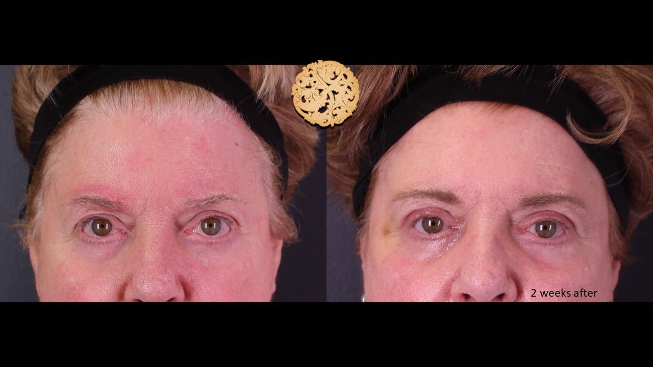 Blepharoplasty Before & After