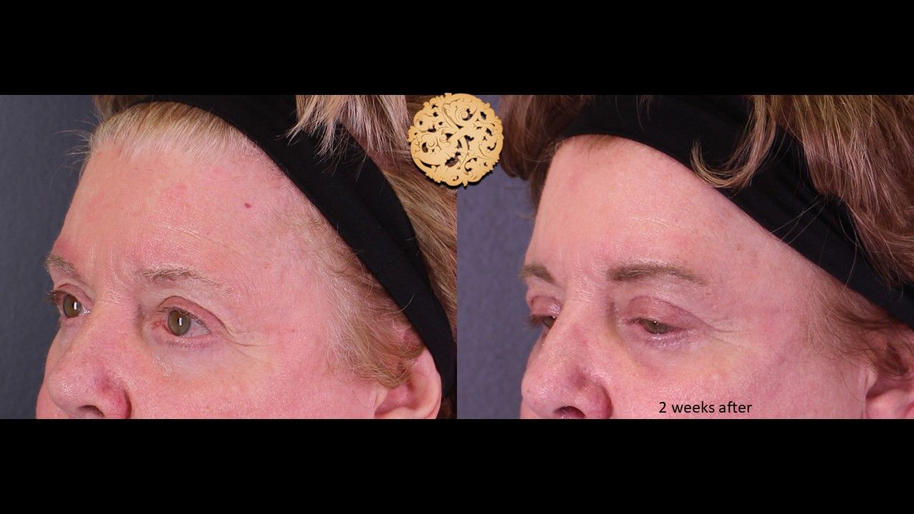 Blepharoplasty Before & After