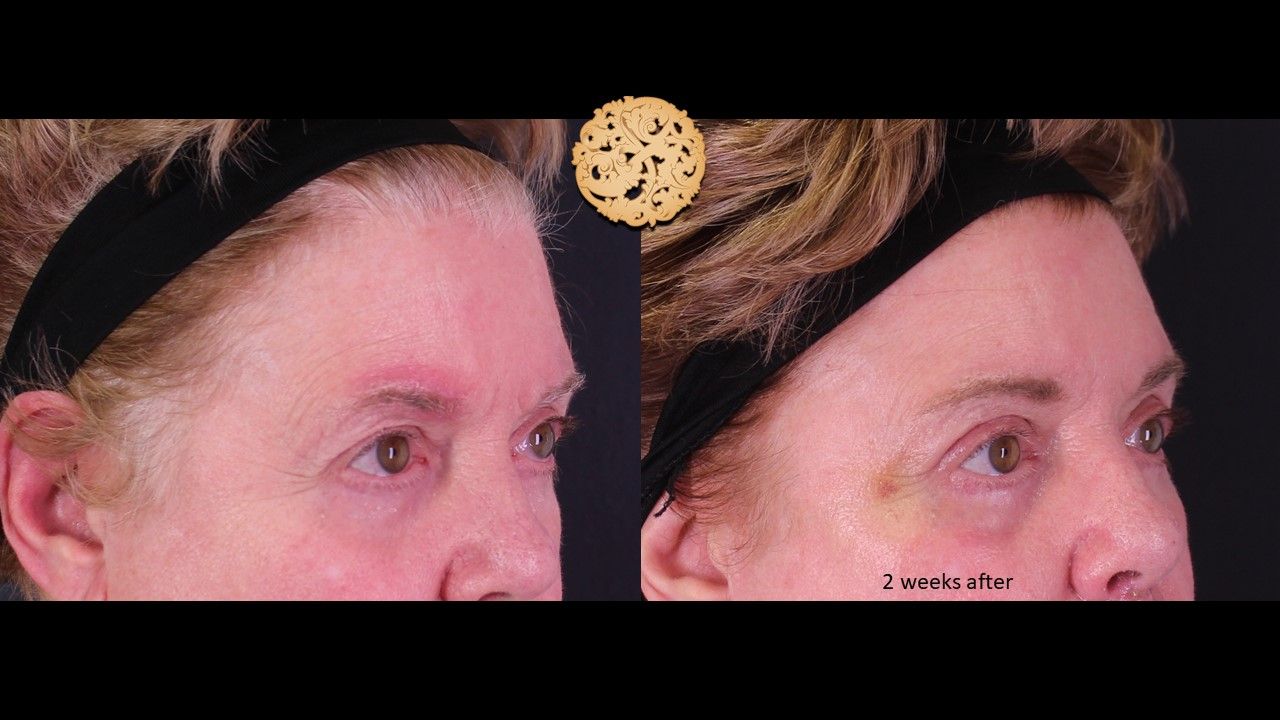 Blepharoplasty Before & After