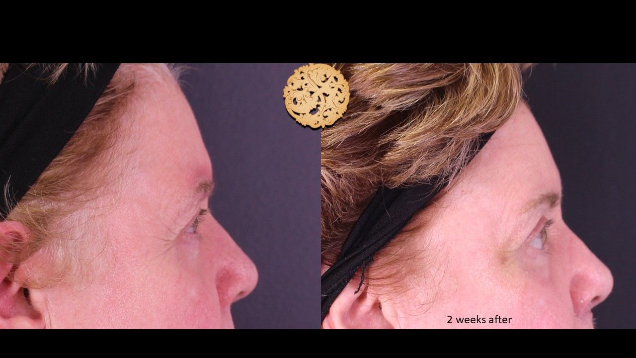Blepharoplasty Before & After