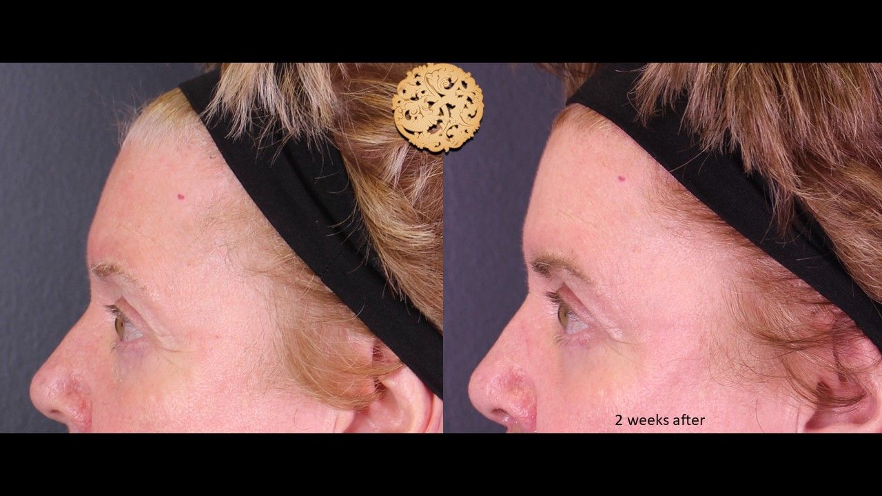 Blepharoplasty Before & After