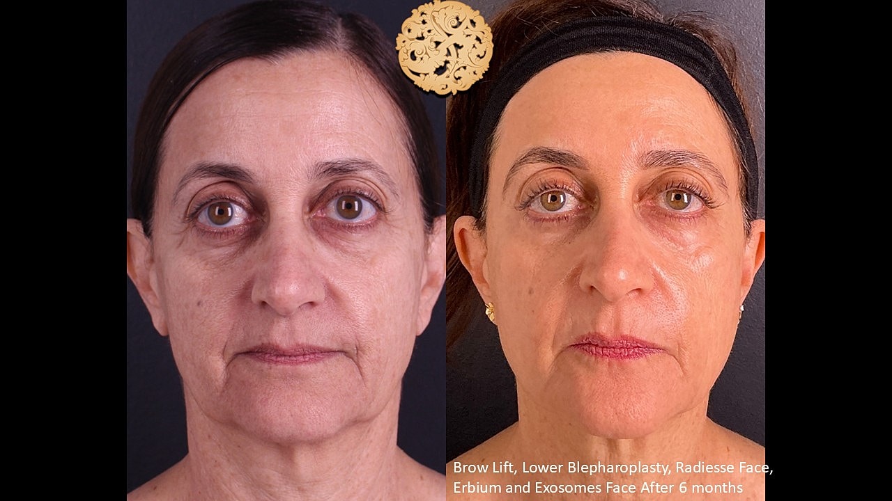 Blepharoplasty Before & After