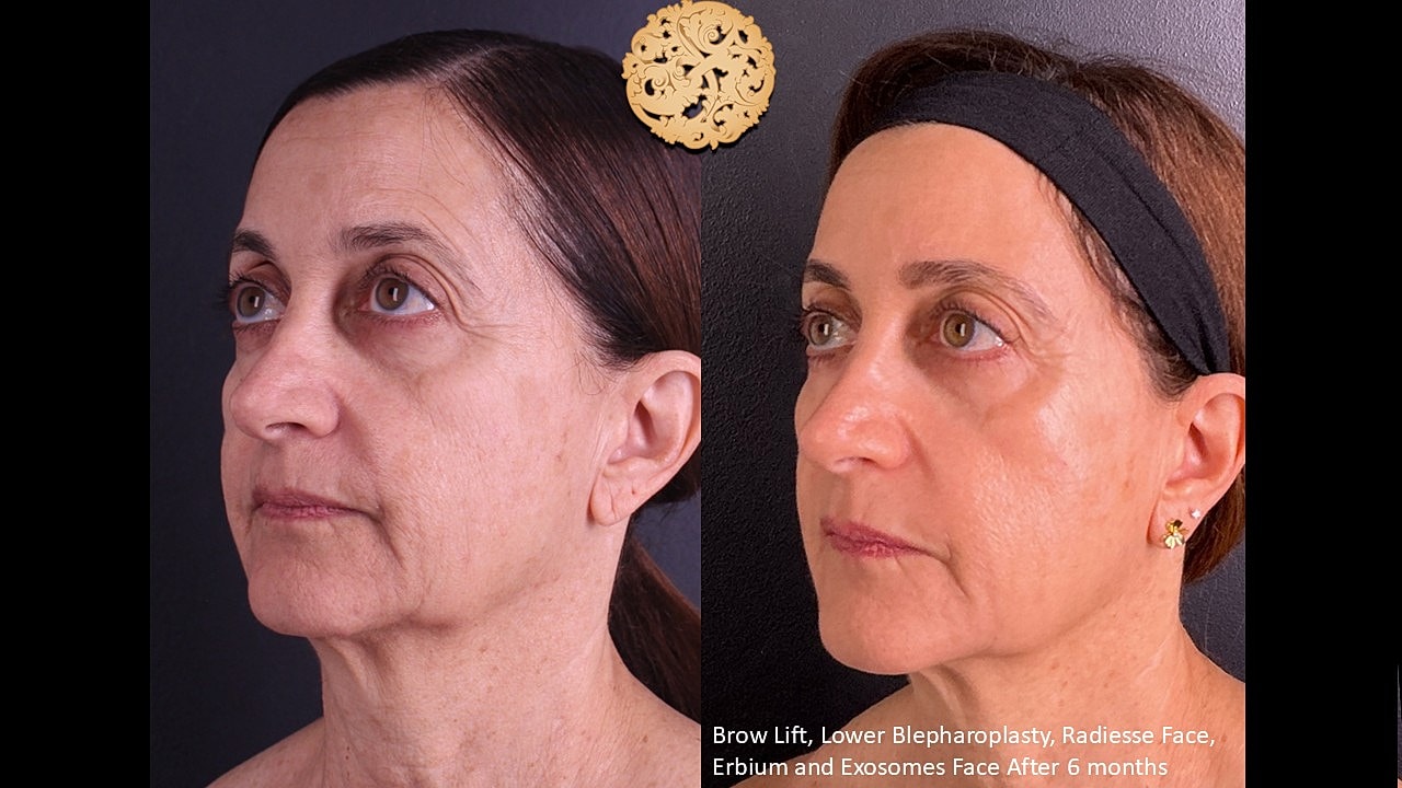 Blepharoplasty Before & After