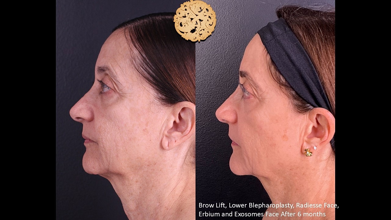 Blepharoplasty Before & After