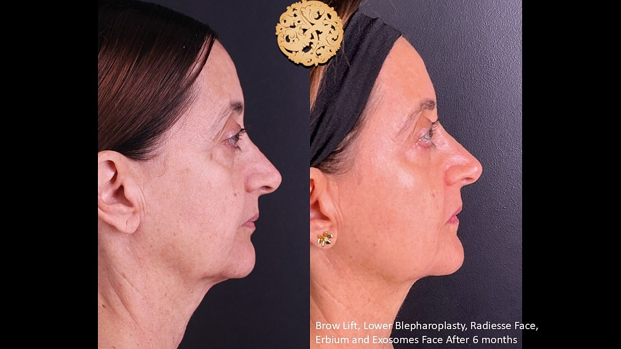 Blepharoplasty Before & After