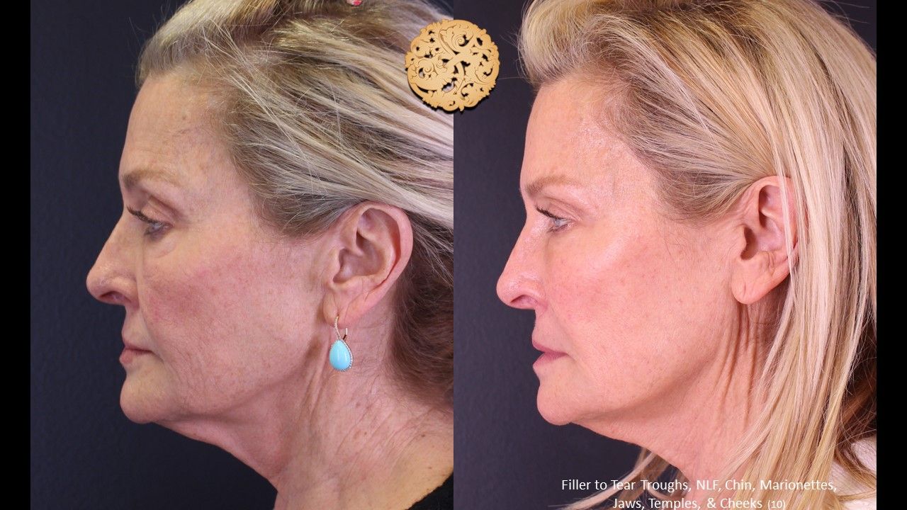 Biolyft Before & After