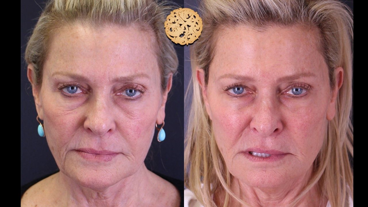 Biolyft Before & After