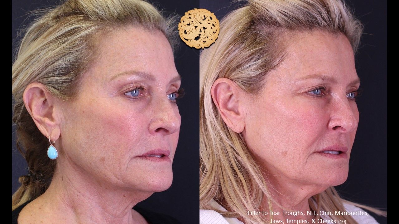 Biolyft Before & After