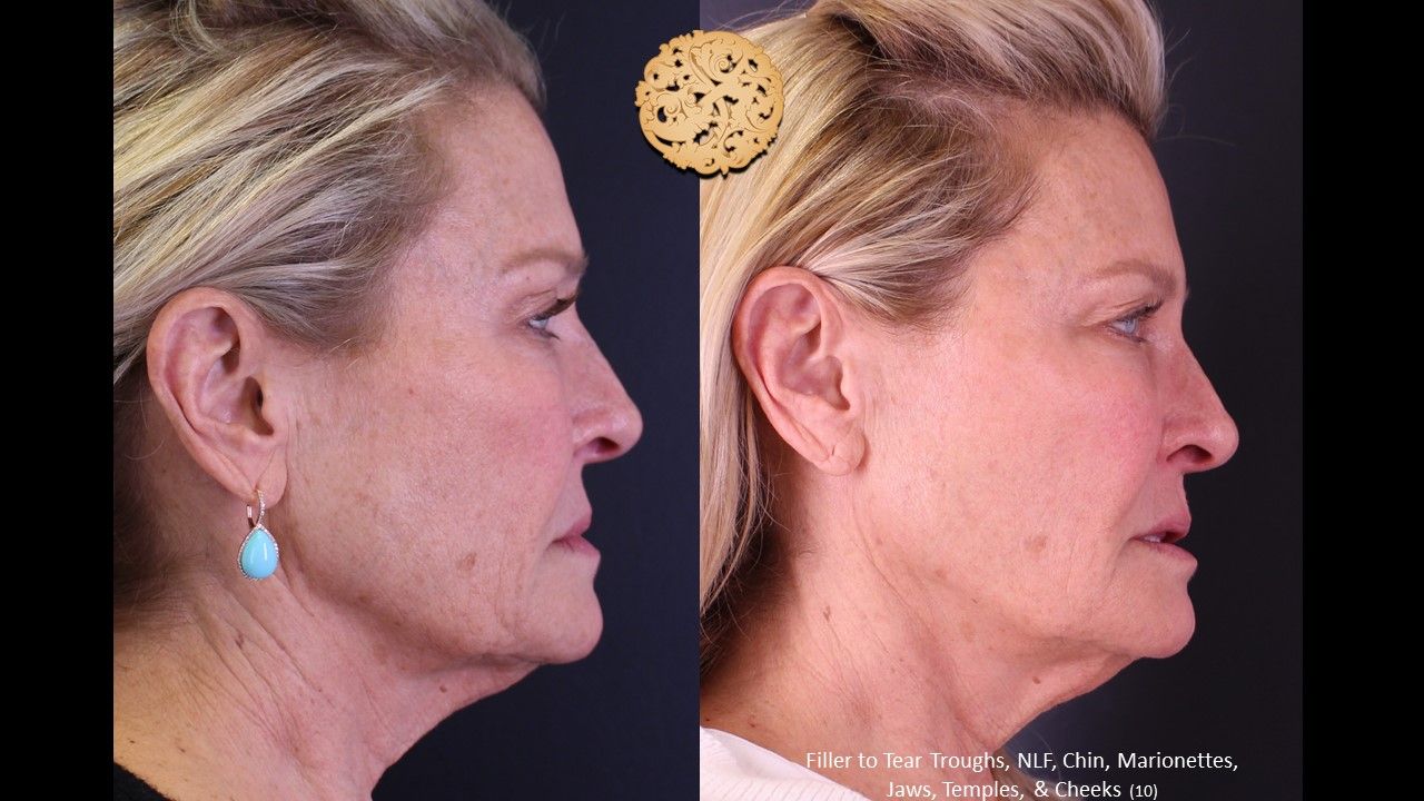 Biolyft Before & After