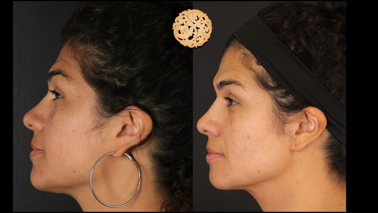 Microneedling Before & After
