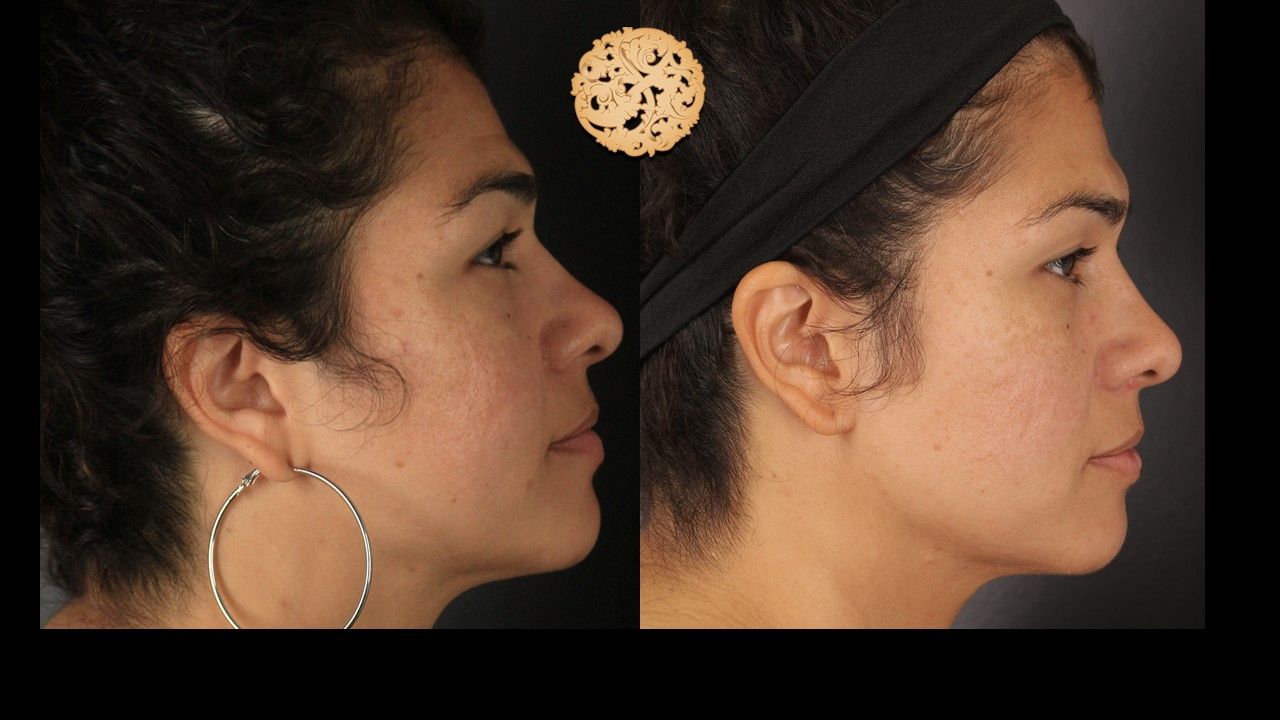Microneedling Before & After