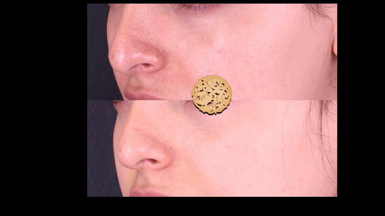 Microneedling Before & After