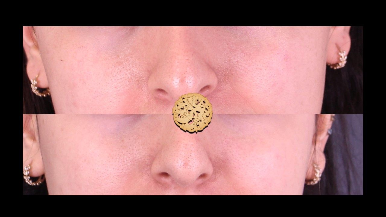 Microneedling Before & After