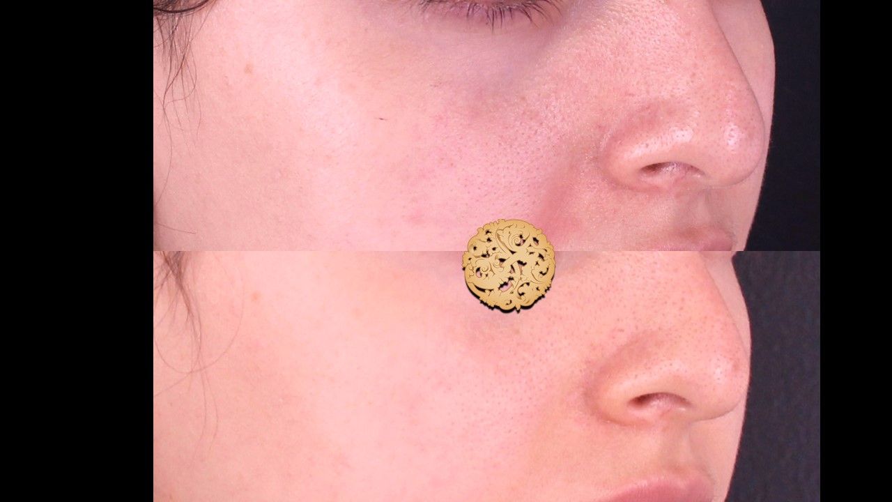 Microneedling Before & After