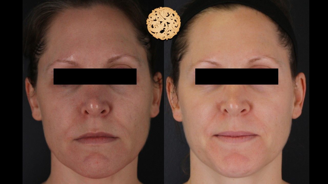 Microneedling Before & After