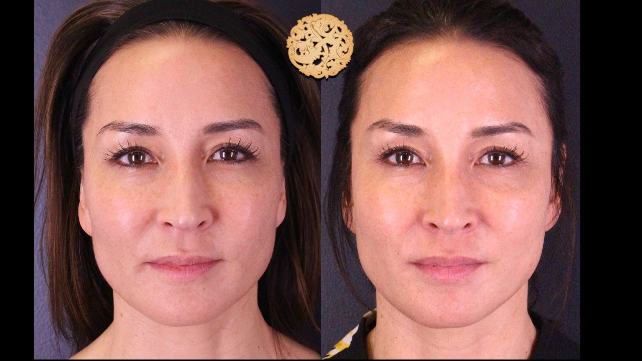 Microneedling Before & After