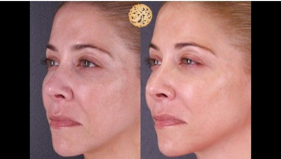 Microneedling Before & After