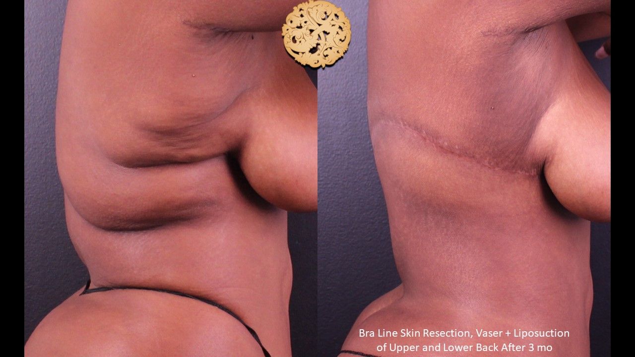 Upper Back Lift Before & After