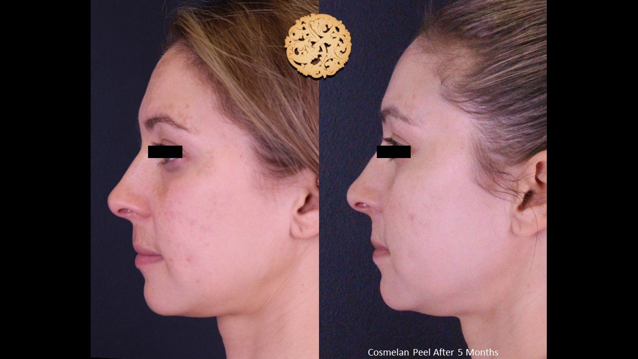 Chemical Peel Before & After