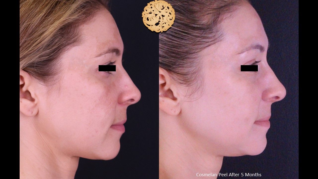 Chemical Peel Before & After