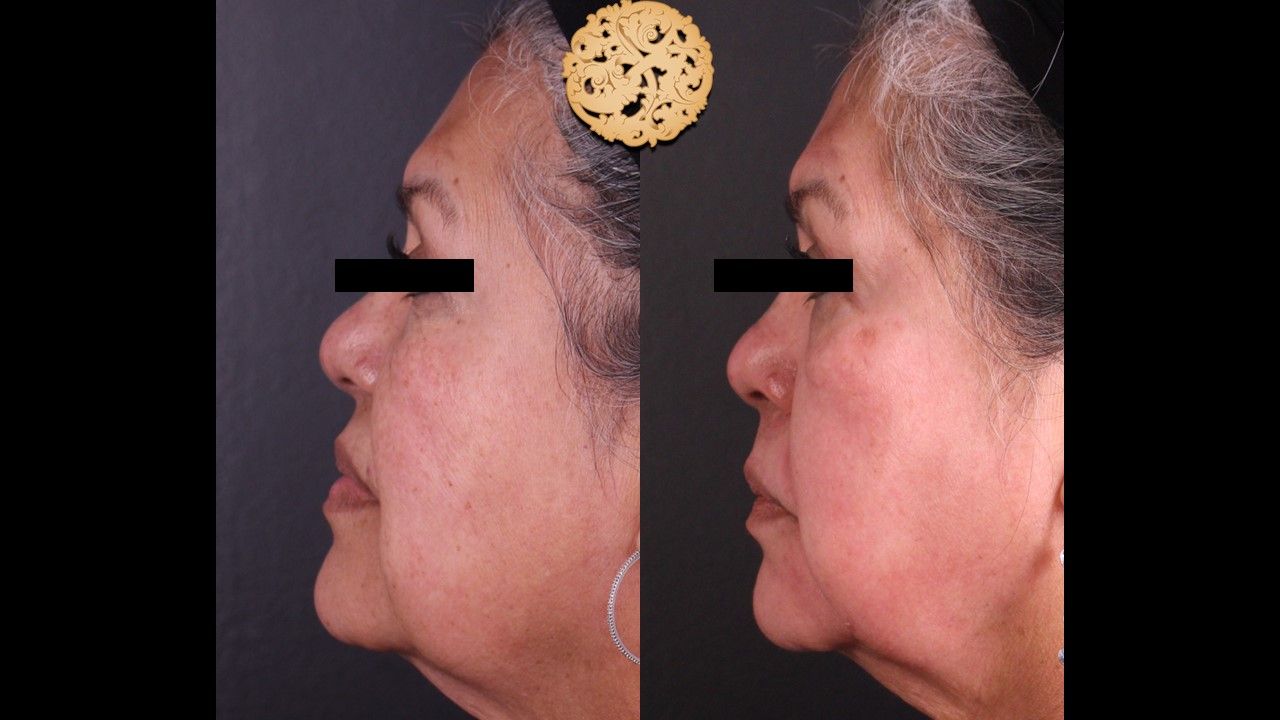 Chemical Peel Before & After