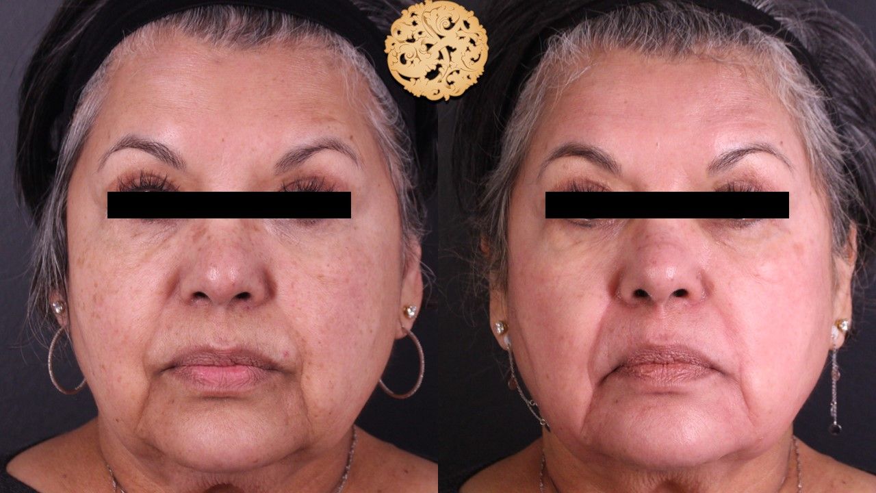 Chemical Peel Before & After