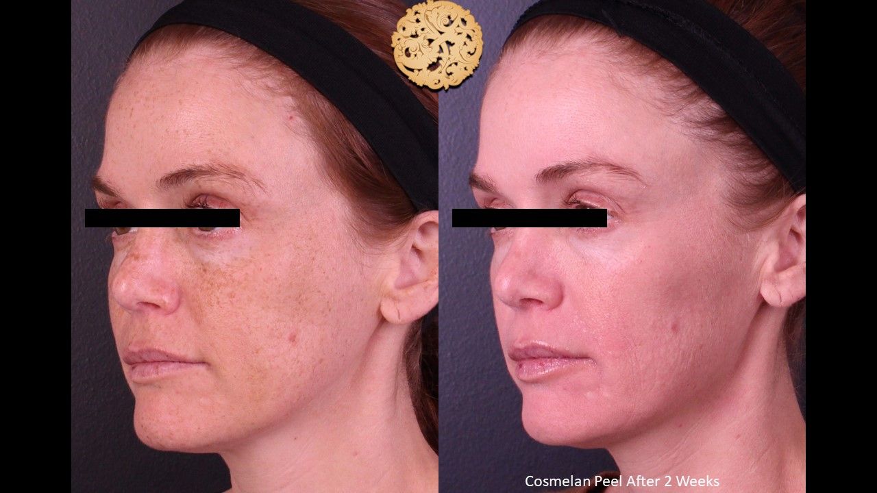 Chemical Peel Before & After