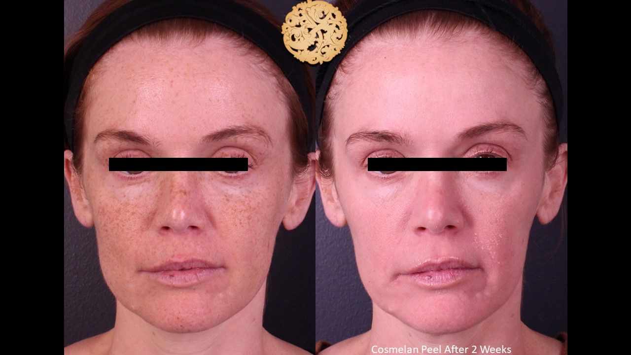 Chemical Peel Before & After