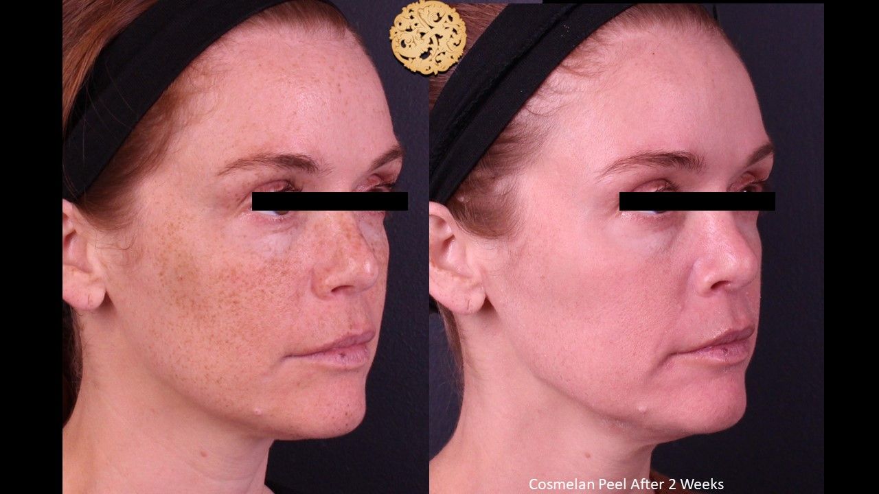 Chemical Peel Before & After