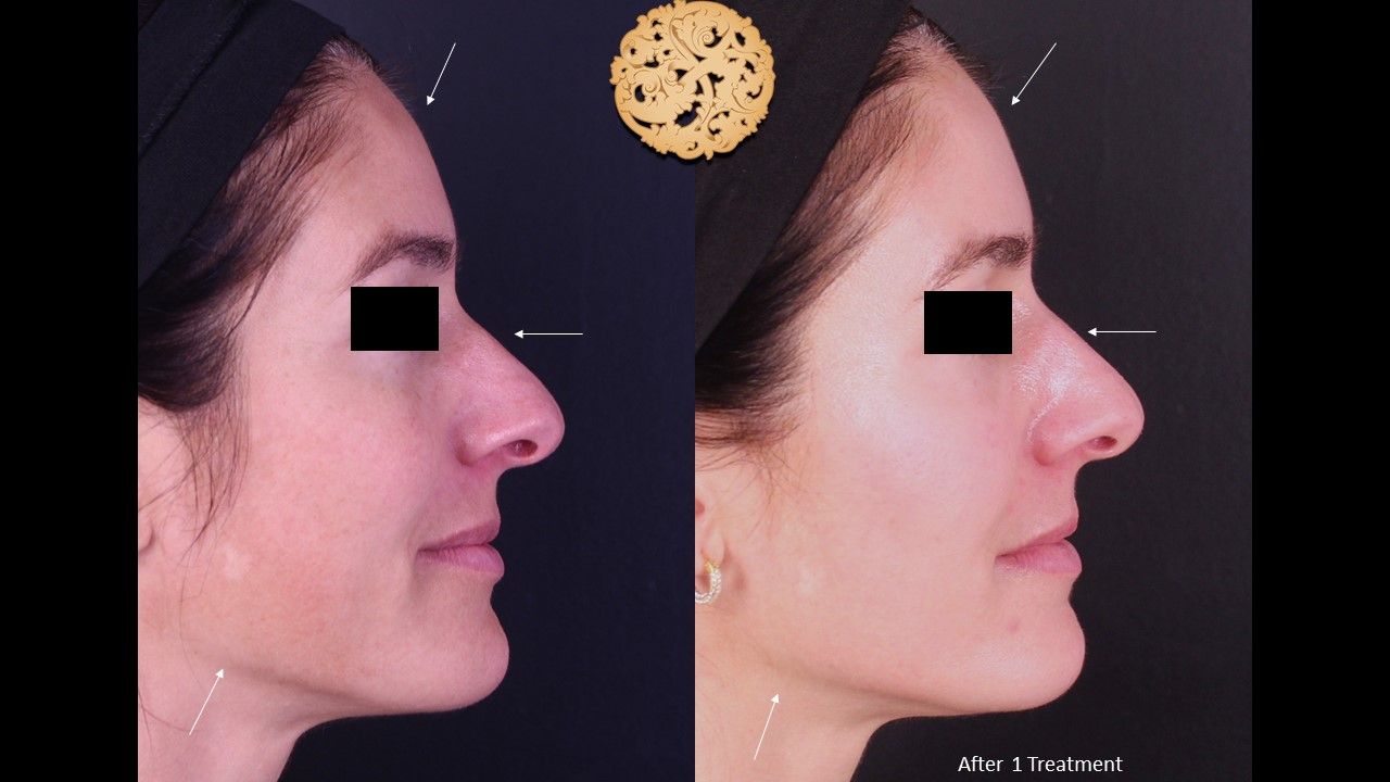 Chemical Peel Before & After