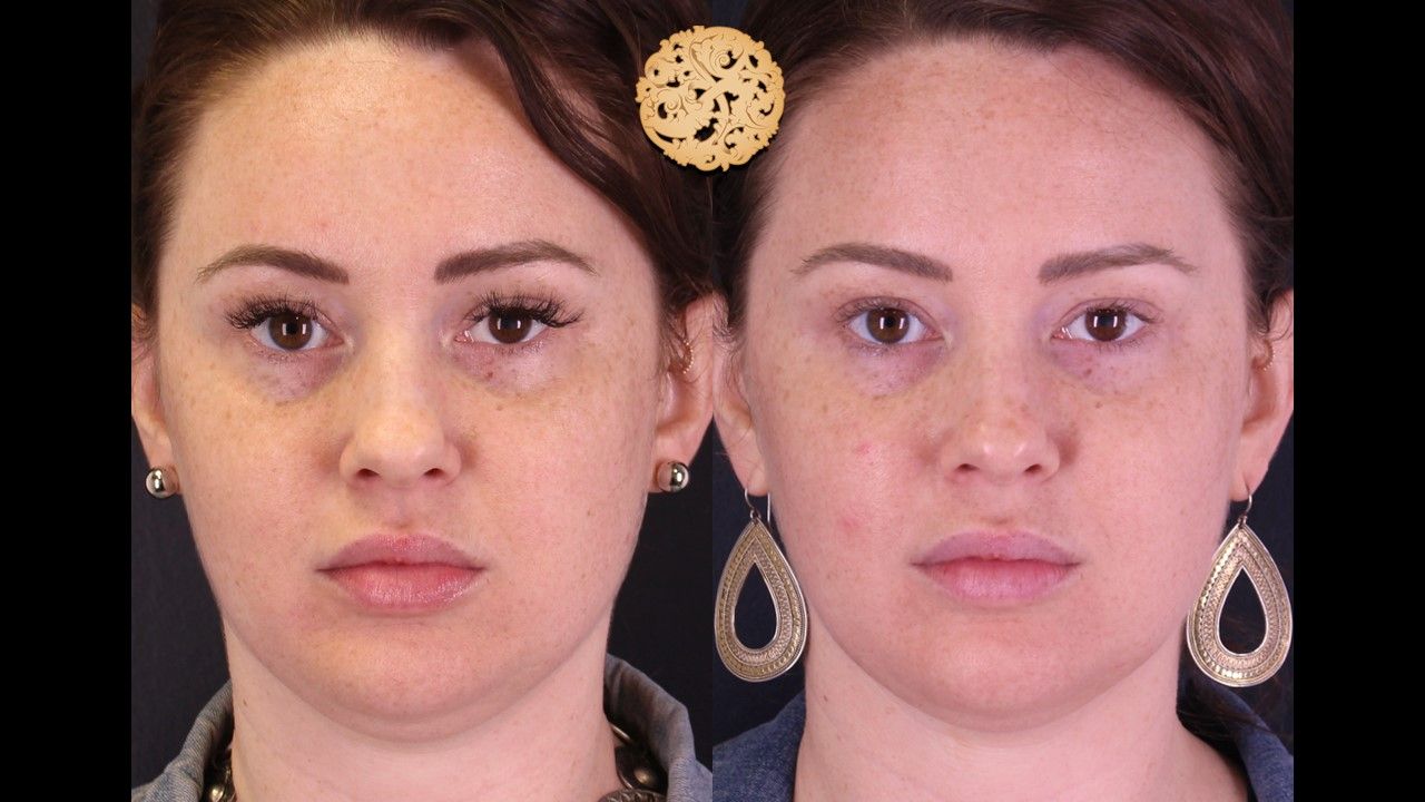 Chemical Peel Before & After