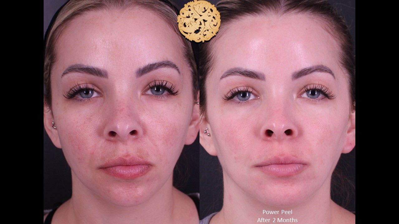 Chemical Peel Before & After