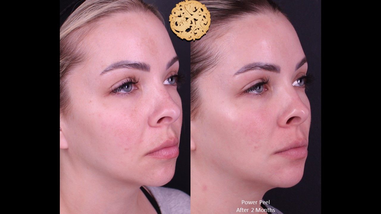 Chemical Peel Before & After
