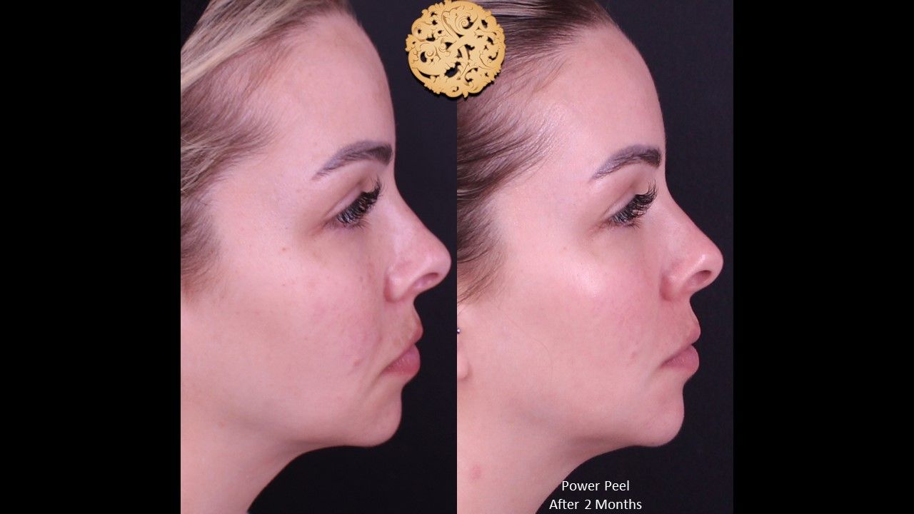 Chemical Peel Before & After