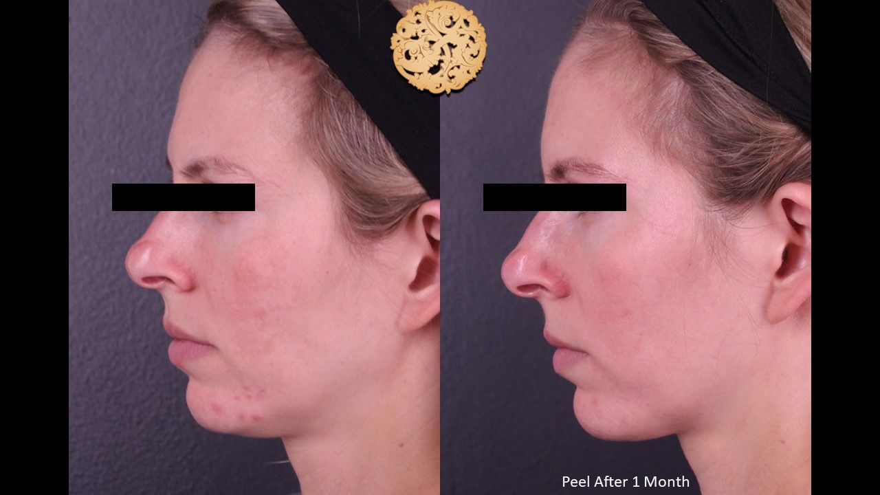 Chemical Peel Before & After