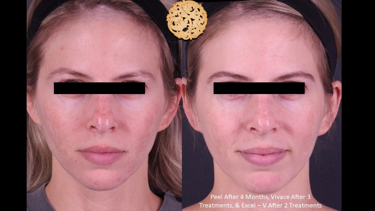 Chemical Peel Before & After