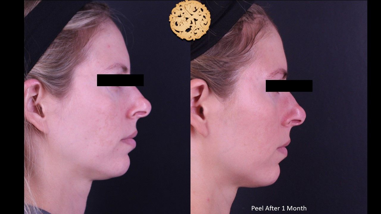 Chemical Peel Before & After