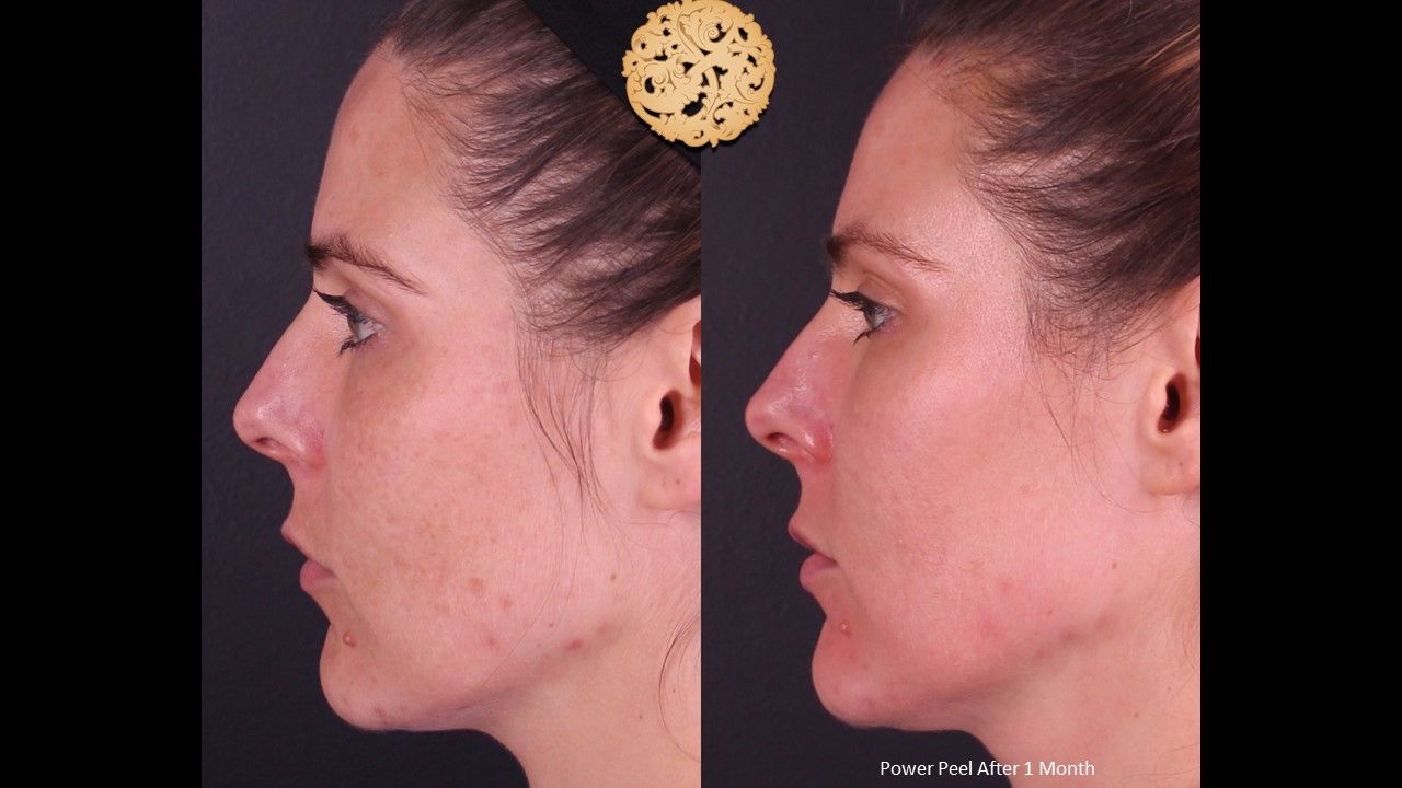 Chemical Peel Before & After