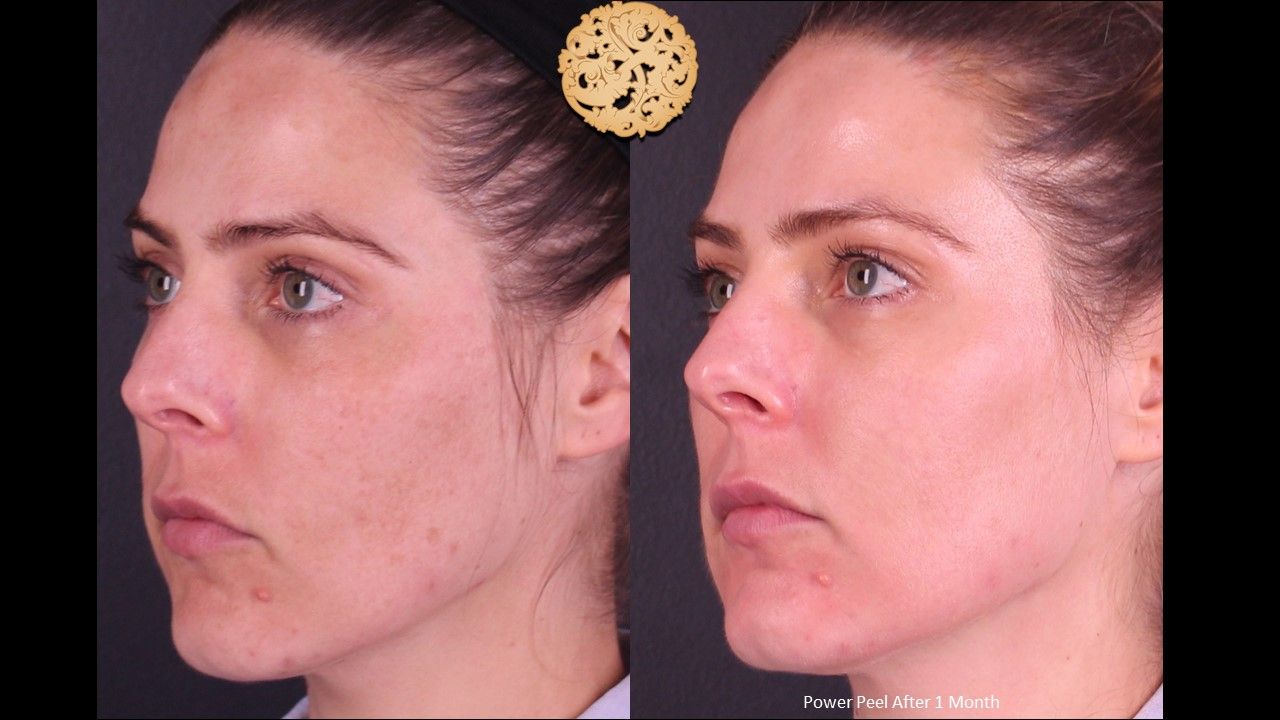 Chemical Peel Before & After