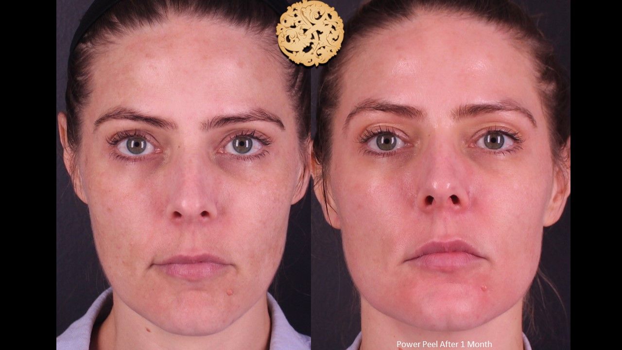 Chemical Peel Before & After