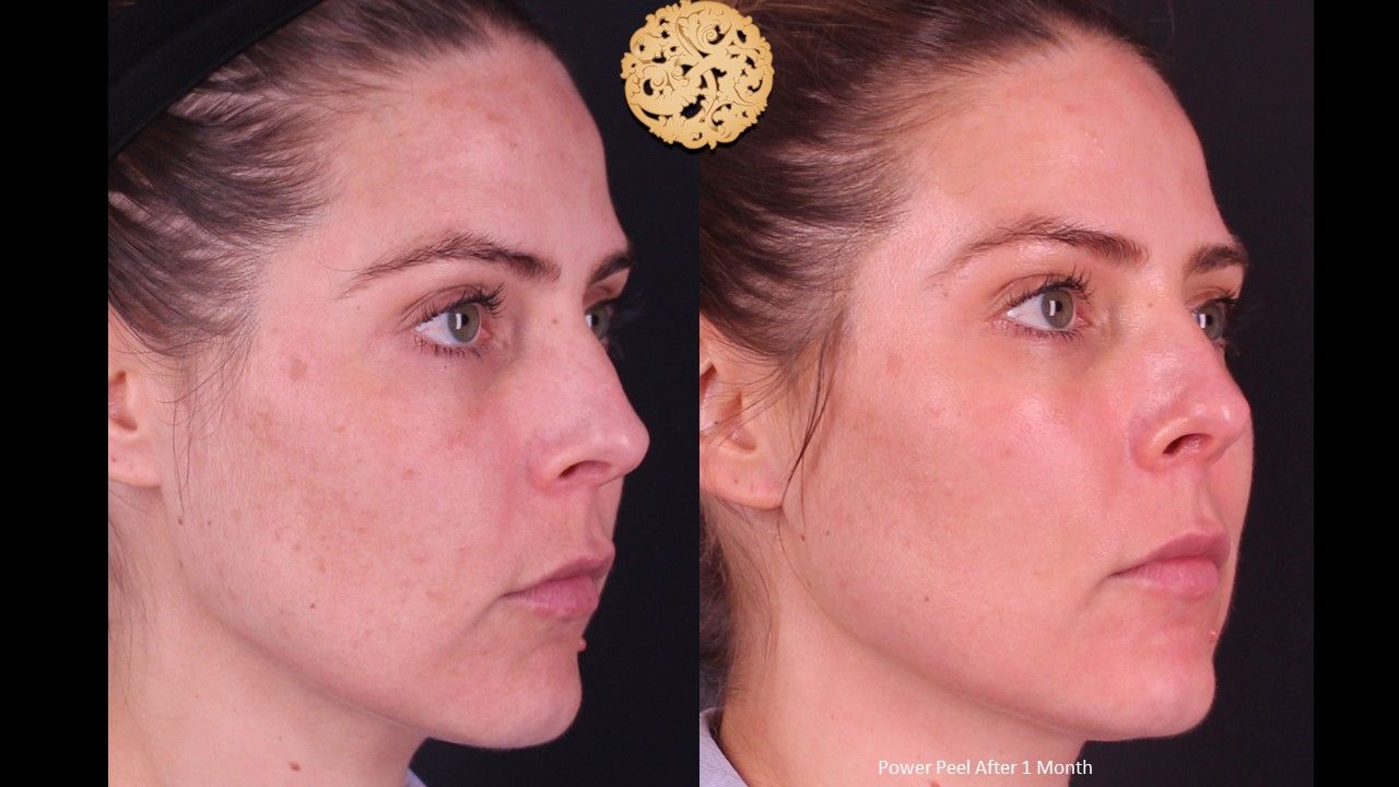 Chemical Peel Before & After