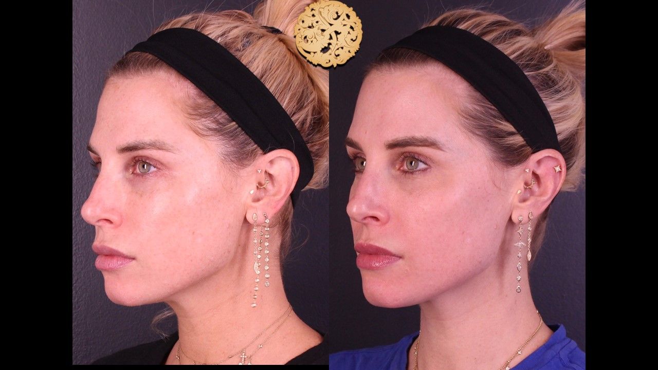 Chemical Peel Before & After