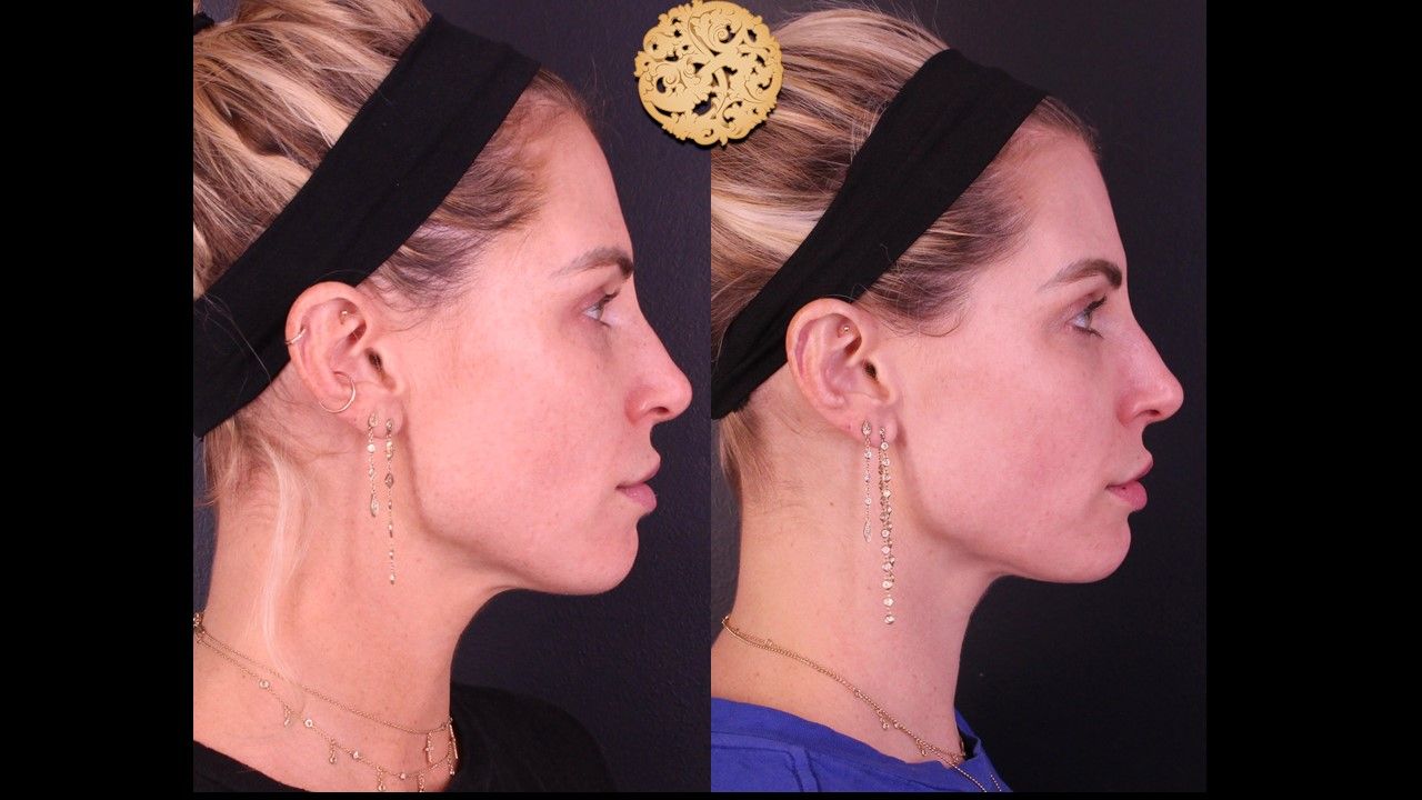 Chemical Peel Before & After