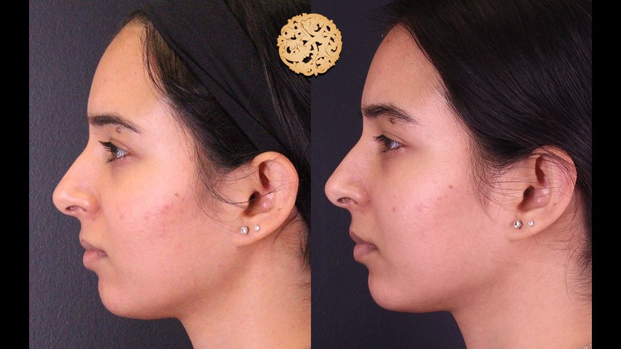 Chemical Peel Before & After